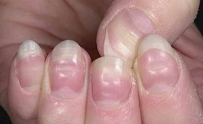 تشخیص بیماری با شکل «ناخن» ها تشخیص بیماری با شکل «ناخن» ها