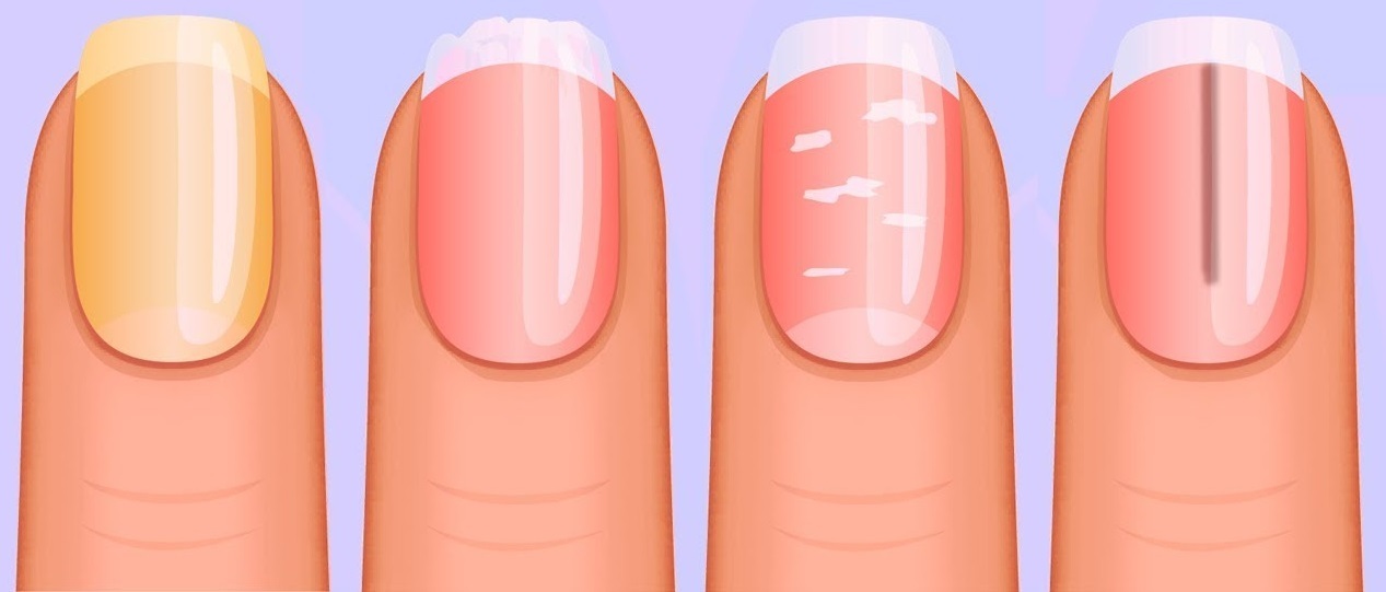 تشخیص بیماری با شکل «ناخن» ها تشخیص بیماری با شکل «ناخن» ها