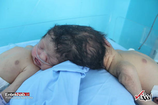 تولد دوقلوهای به هم چسبیده در افغانستان +عکس تولد دوقلوهای به هم چسبیده در افغانستان +عکس