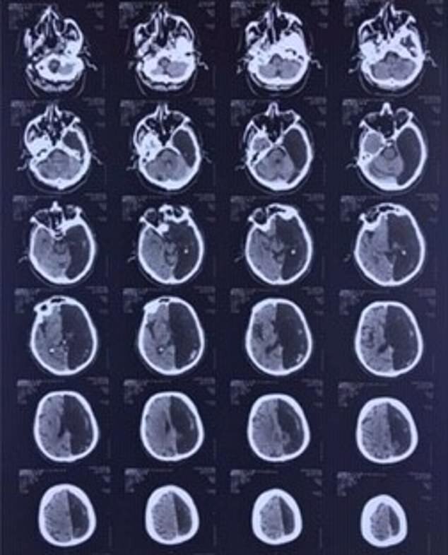 مردی که فقط با نیمی از مغز زنده است! مردی که فقط با نیمی از مغز زنده است!