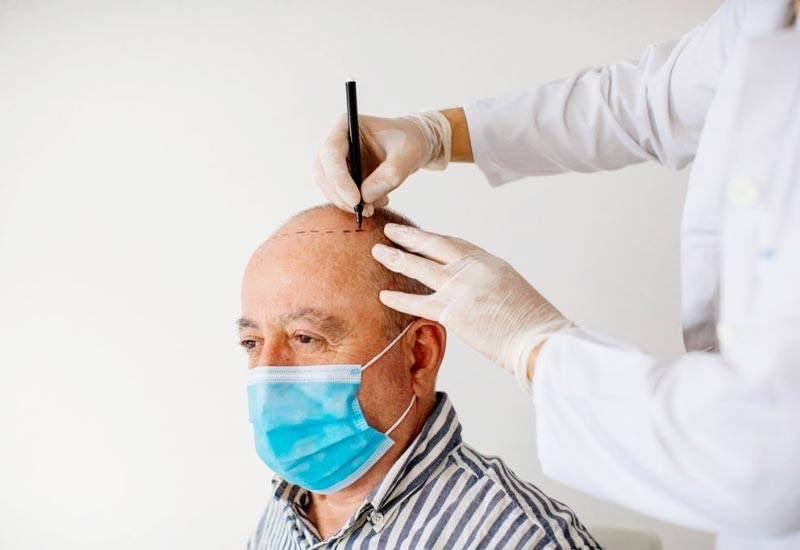 آشنایی با مراقبت های لازم قبل از کاشت مو