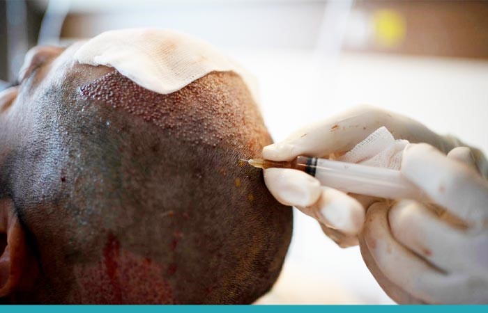 آشنایی با مراقبت های لازم قبل از کاشت مو آشنایی با مراقبت های لازم قبل از کاشت مو