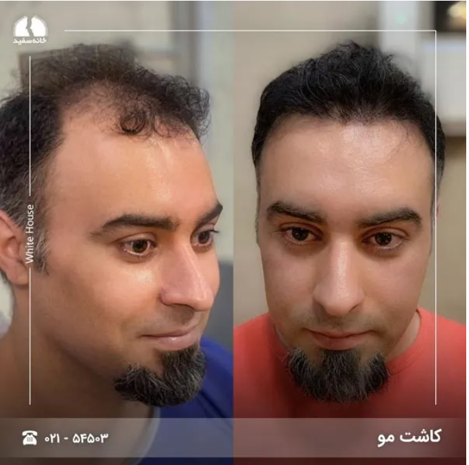 آشنایی با مراحل کاشت مو طبیعی آشنایی با مراحل کاشت مو طبیعی