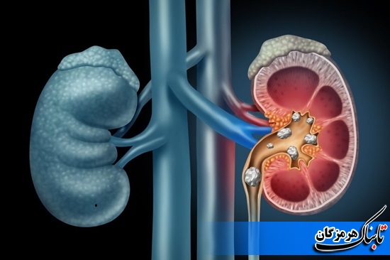 12درصد مردان و 5 درصد زنان در طول زندگی به سنگ کلیه مبتلا می شوند