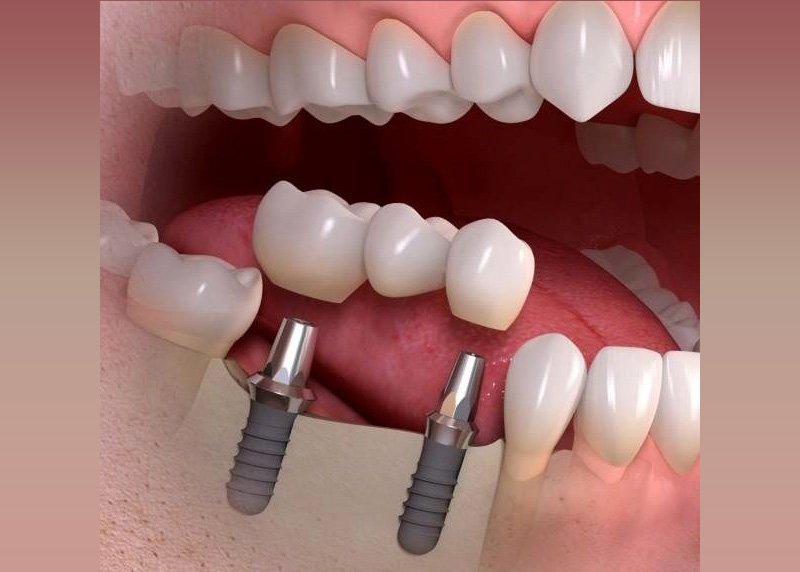 همه چیز در خصوص ایمپلنت فوری(0تا100) همه چیز در خصوص ایمپلنت فوری(0تا100)