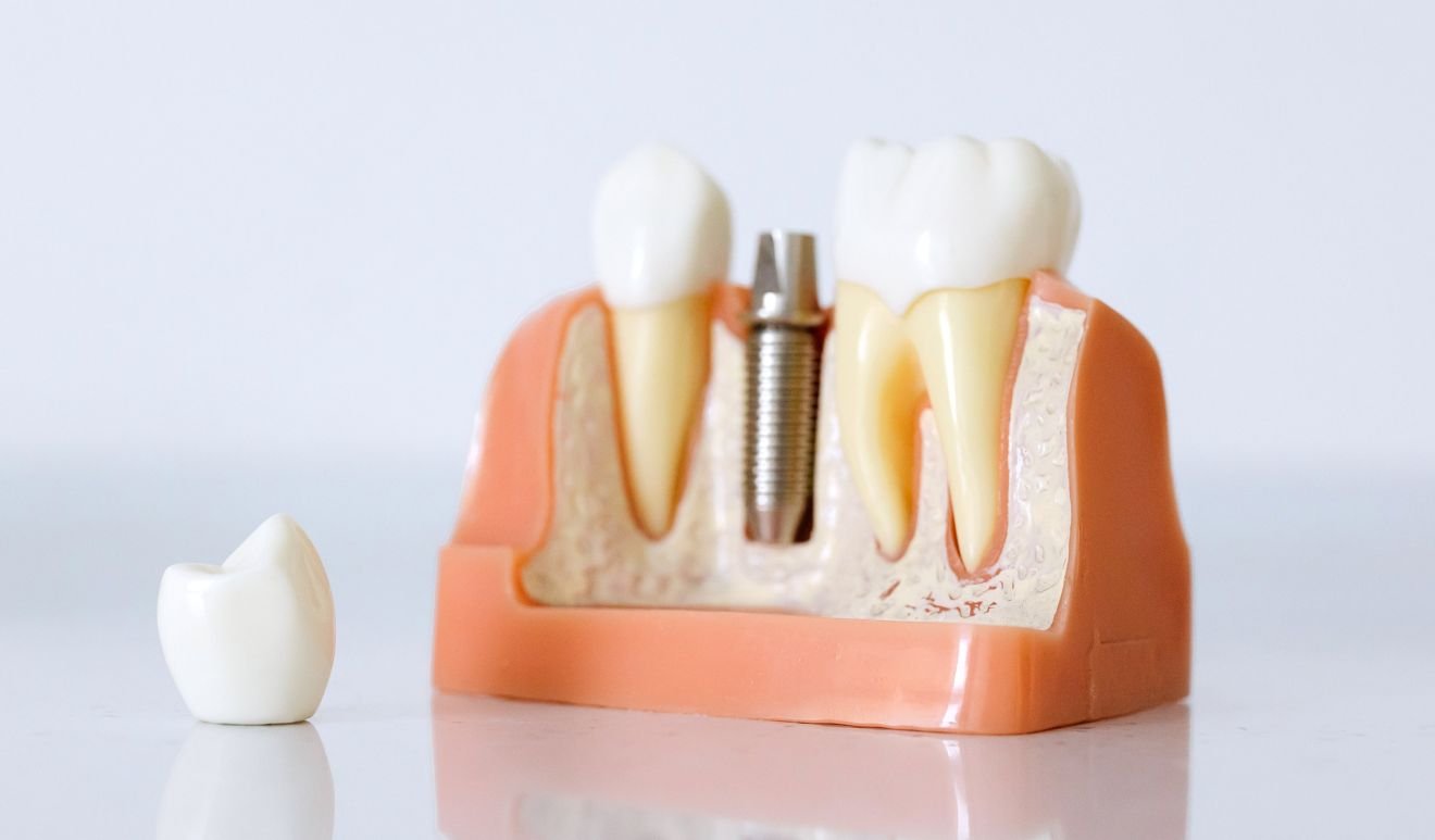 تشخیص ایمپلنت تقلبی تشخیص ایمپلنت تقلبی