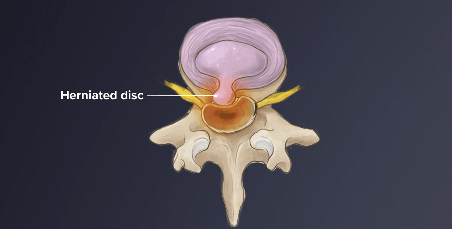 عمل دیسک گردن چیست + ویزیت رایگان