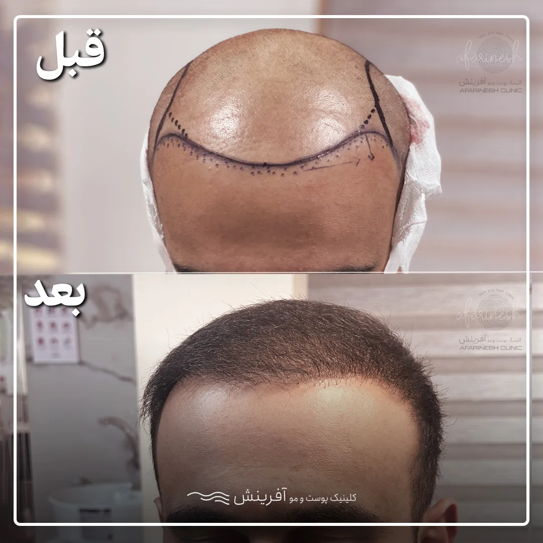 با به روزترین روشهای کاشت مو در ایران آشنا شوید به روزترین روشهای کاشت مو